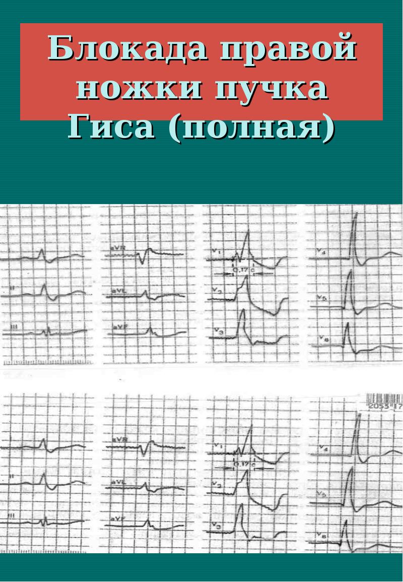 Полная блокада правой ножки пучка гиса