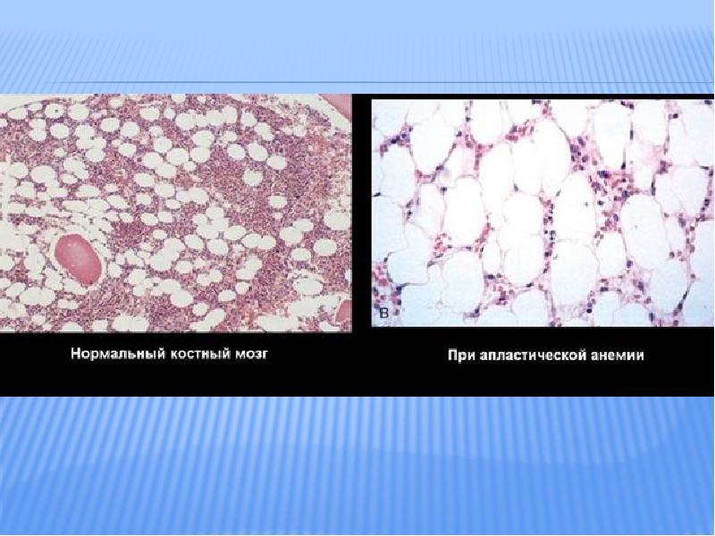 Дифференциальная диагностика анемий у детей презентация