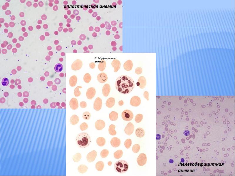 Диф диагностика анемий презентация