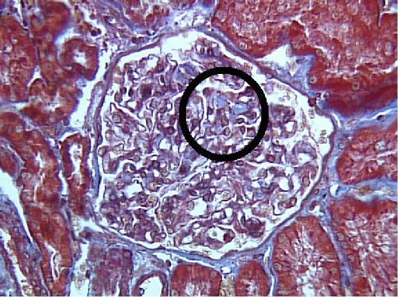 Гломерулонефрит при амилоидозе. Амилоидоз почки макропрепарат. Дифференциальный диагноз туберкулеза почки. Амилоидный нефроз макропрепарат. Гломерулонефрит при амилоидозе.