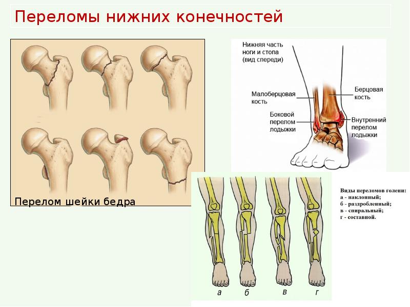 Переломы голени презентация