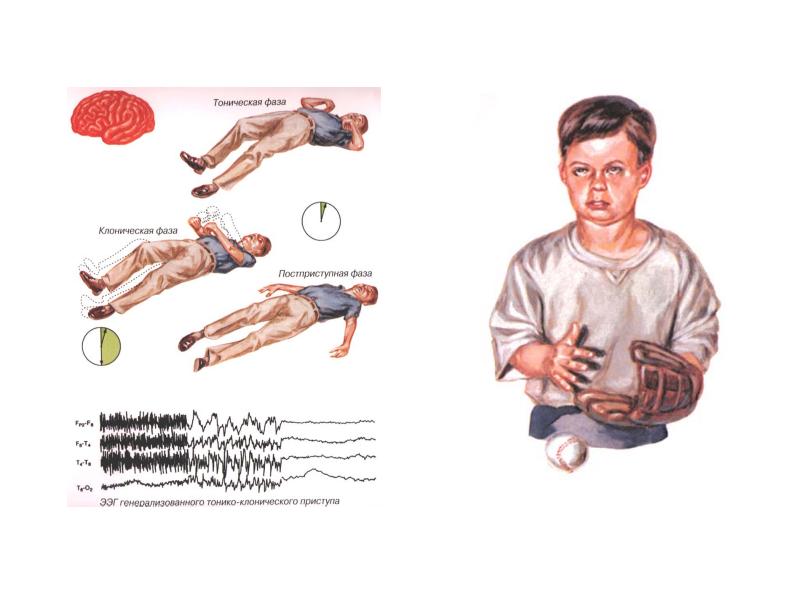 Эпилептический статус неврология презентация