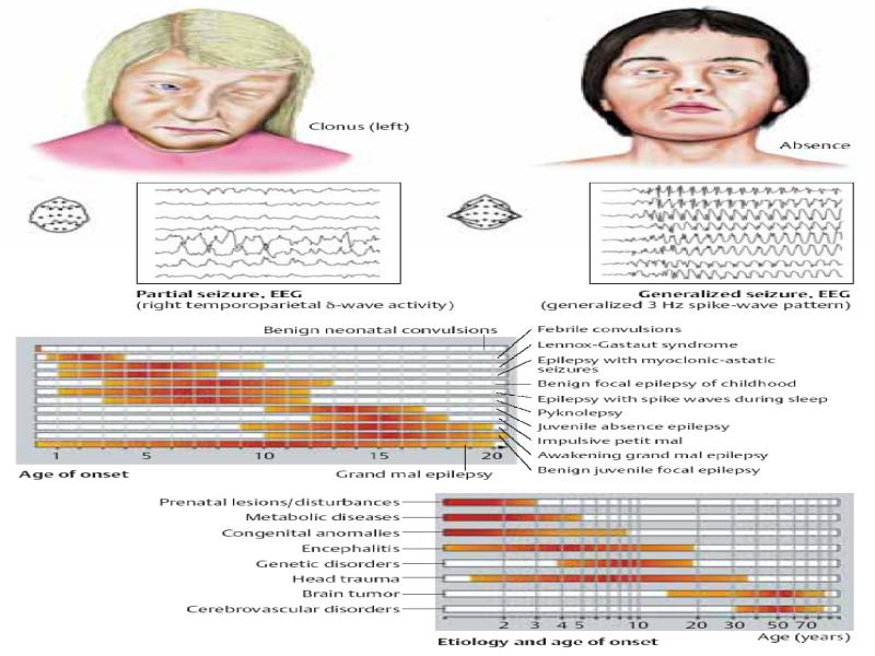 Эпилепсия генетика. Эпилептический статус классификация. Классификации эпилептических припадков (Киото, 1984 год). Классификации эпилепсии и эпилептических синдромов (Нью-Йорк, 1989 г.. Патогенез эпилепсии.