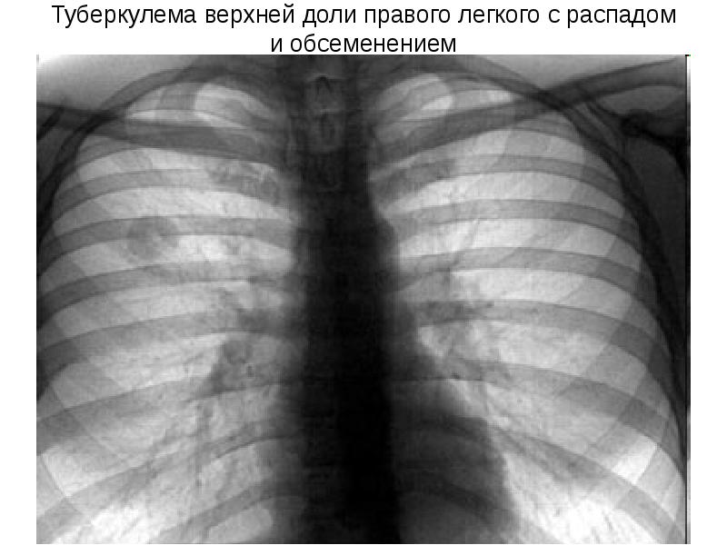 Реферат: Туберкулема правого легкого