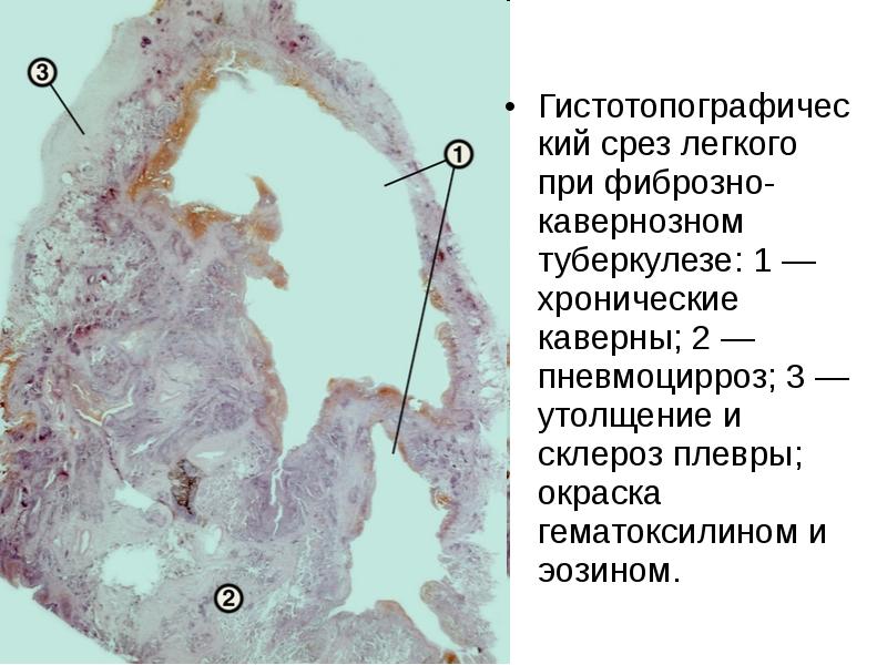 Туберкулезная каверна микропрепарат рисунок