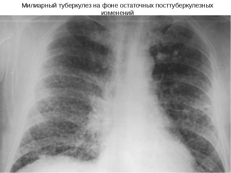 Туберкулез на флюорографии фото