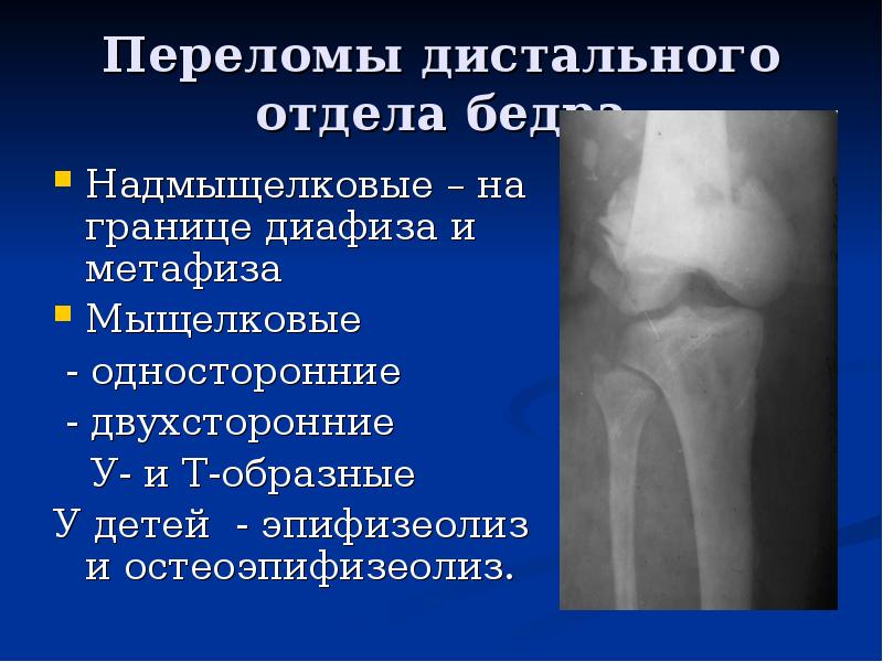 Презентация про переломы