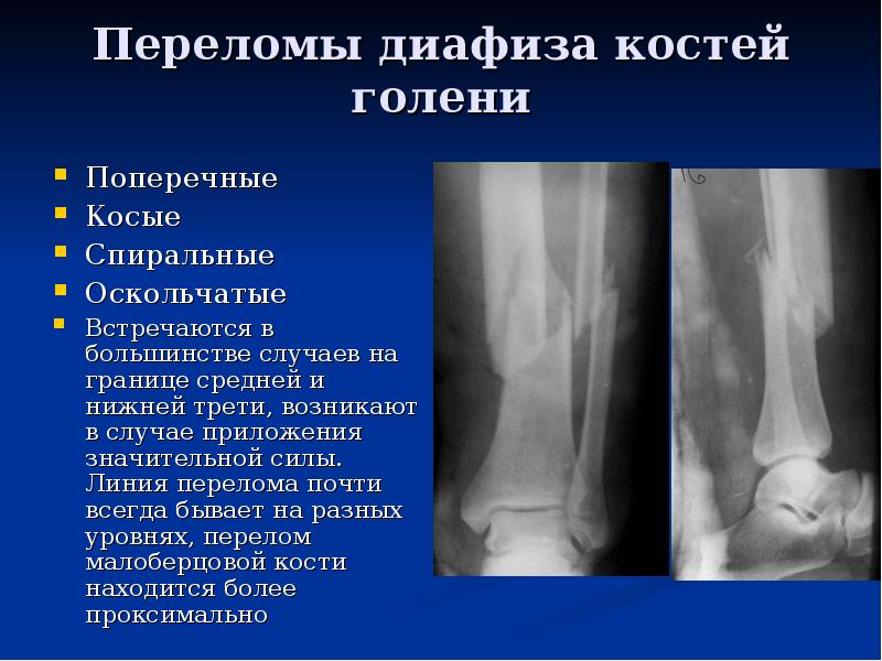 Оскольчатый перелом малоберцовой кости