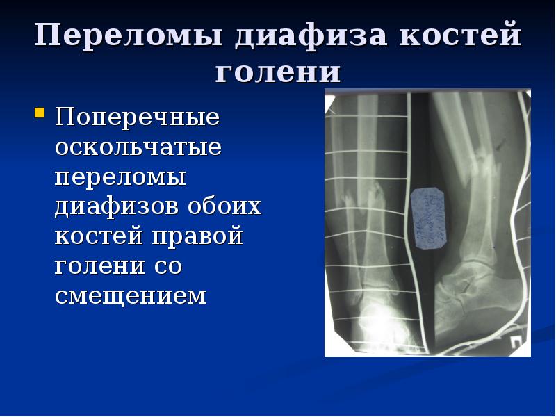 Двухлодыжечный перелом голени карта вызова