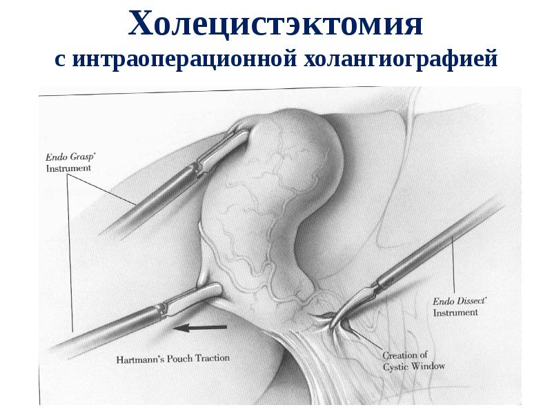 Перенесенная холецистэктомия