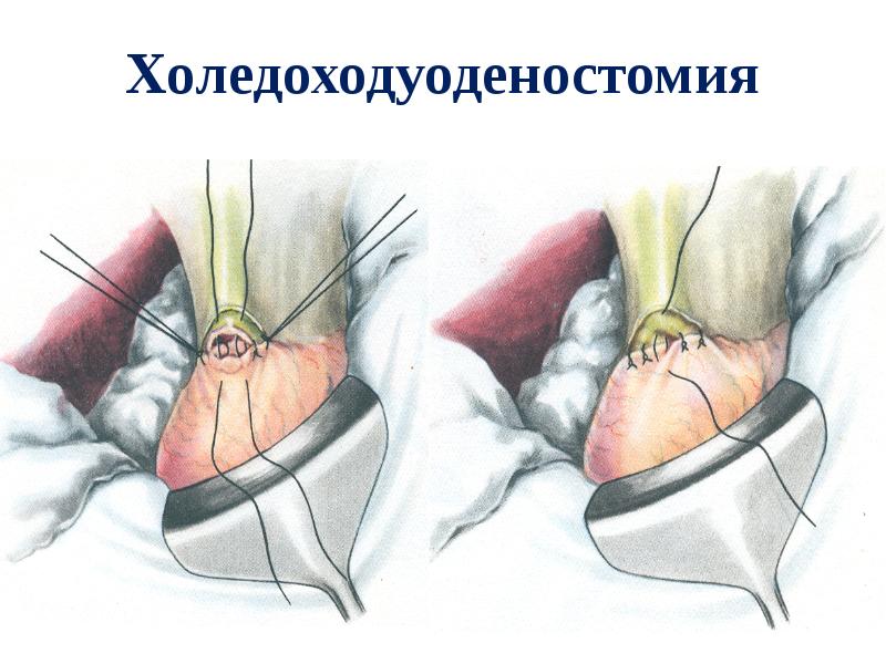 Холедоходуоденостомия