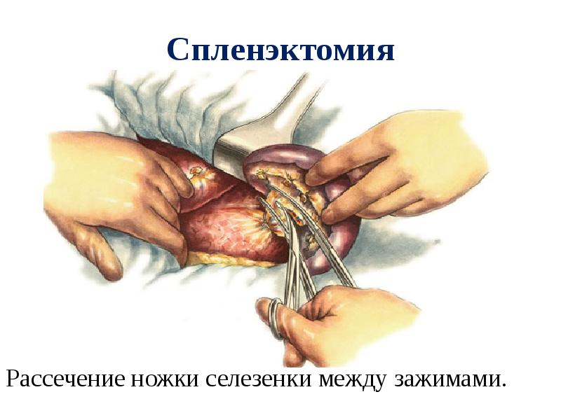 Презентация операции на поджелудочной железе