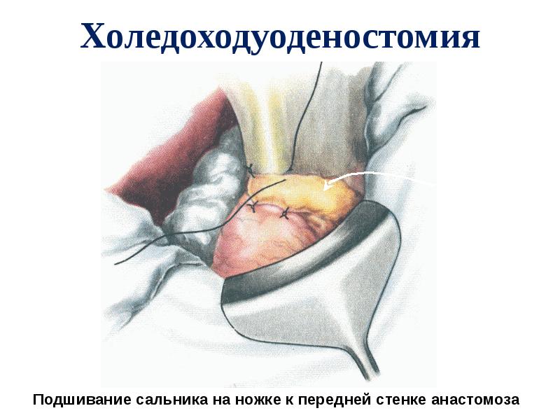 Холедоходуоденостомия