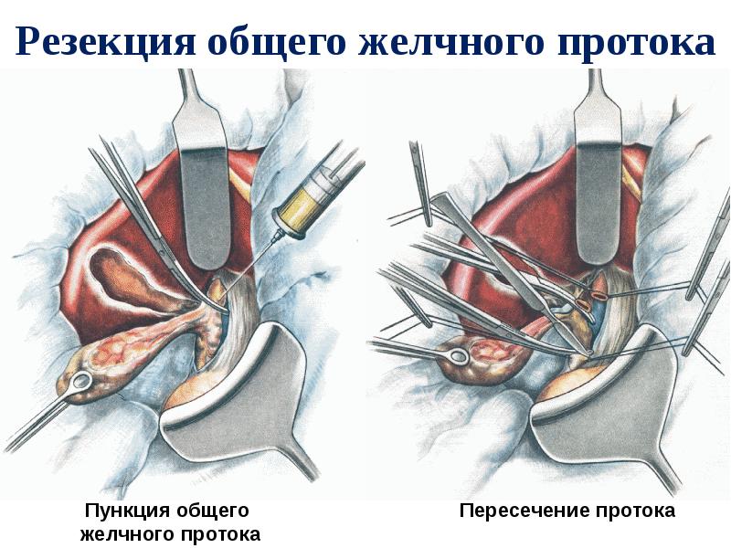 Резекция общего желчного протока