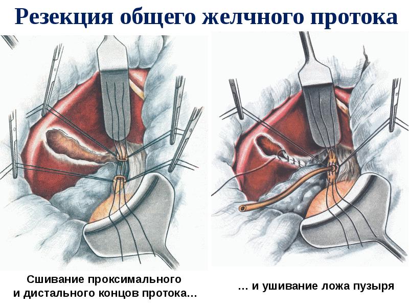 Резекция общего желчного протока