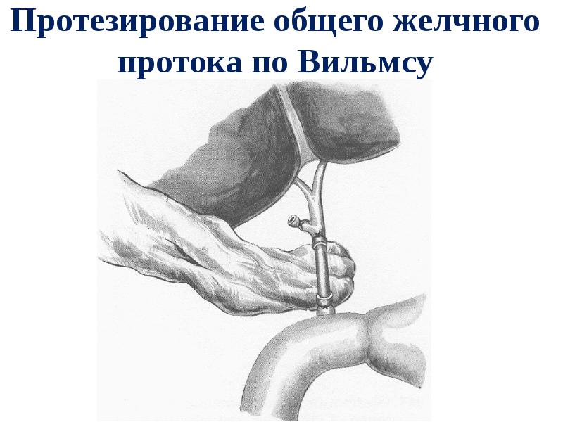Протезирование общего желчного протока по Вильмсу