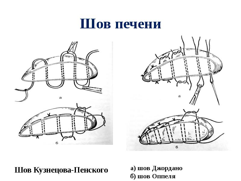 Шов печени Шов Кузнецова-Пенского