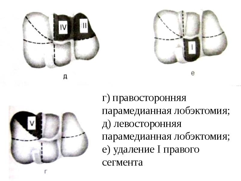 г) правосторонняя парамедианная лобэктомия;  д) левосторонняя парамедианная лобэктомия; е) удаление