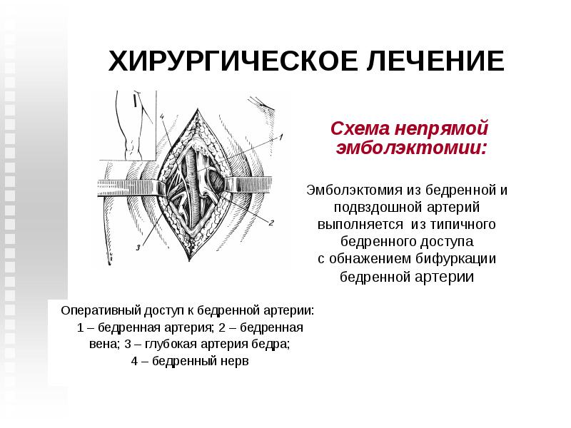обнажение и перевязка бедренной артерии. перевязка артерии на протяжении.