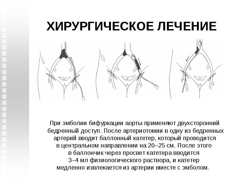 Схема операции удаления эмбола из бифуркации аорты