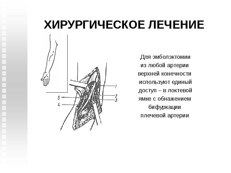Тромбоэмболия артерий конечностей. Проекционные линии магистральных артерий конечностей. Эмболия плечевой артерии. Эмболэктомия из бедренной артерии. Тромбэктомия из артерий верхней конечности.