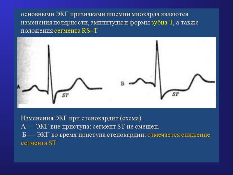 Ишемия на экг фото