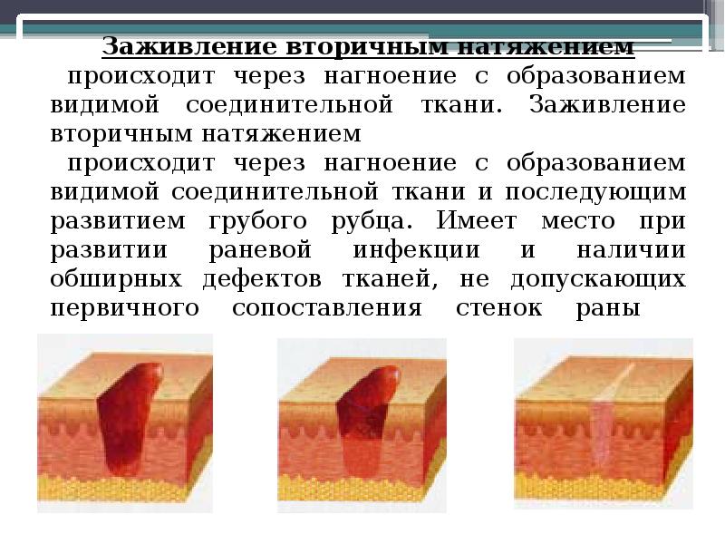 Первичное и вторичное натяжение раны