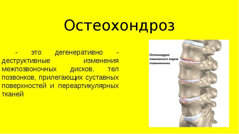 Дегенеративные заболевания позвоночника презентация