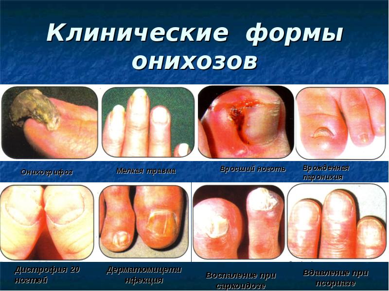 Грибковые заболевания кожи классификация симптомы принципы лечения тела и фото