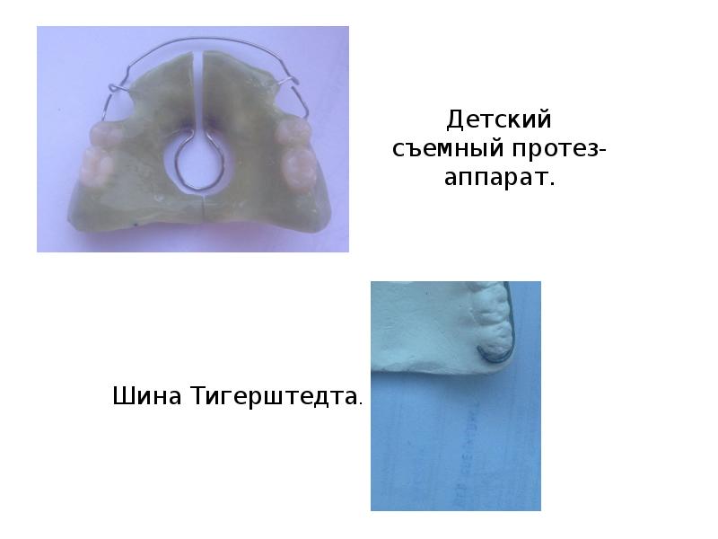 Частичный съемный пластиночный протез на верхнюю челюсть фото