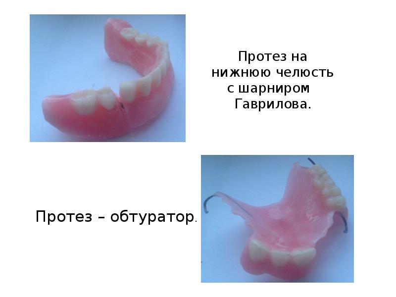 Пластиночные протезы презентация