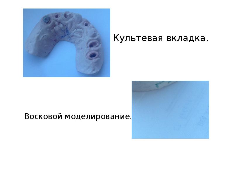 Пластиночные протезы презентация