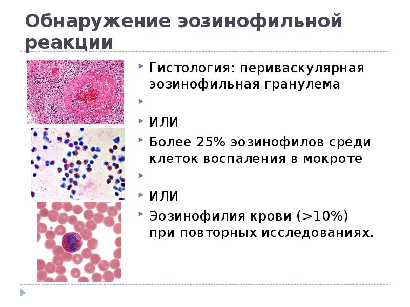 Эозинофилы цвет. Гистология эозинофильной гранулемы. Эозинофилы гистология. Эозинофильная гранулема гистология. Эозинофильное воспаление.