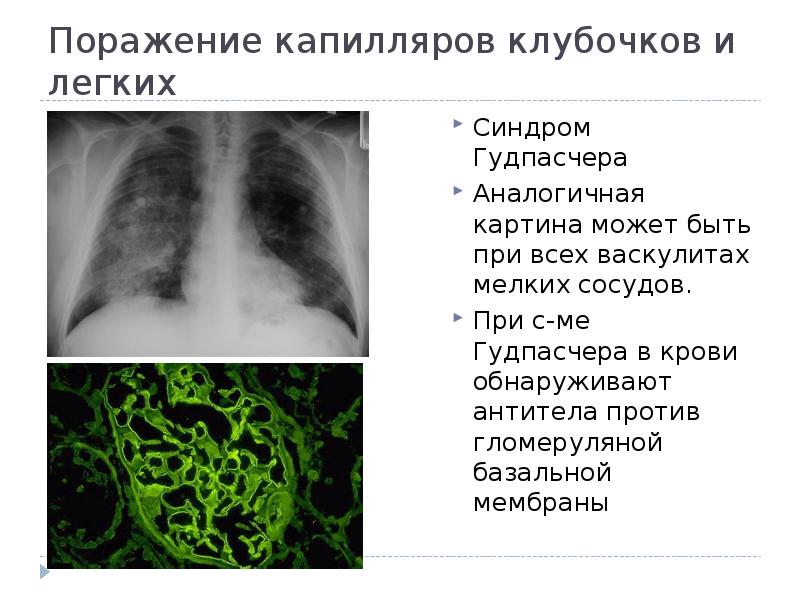 Поражение капилляров. Поражение капилляров. Поражение капилляров. Поражение сосудов атеросклерозом. Поражение капилляров.