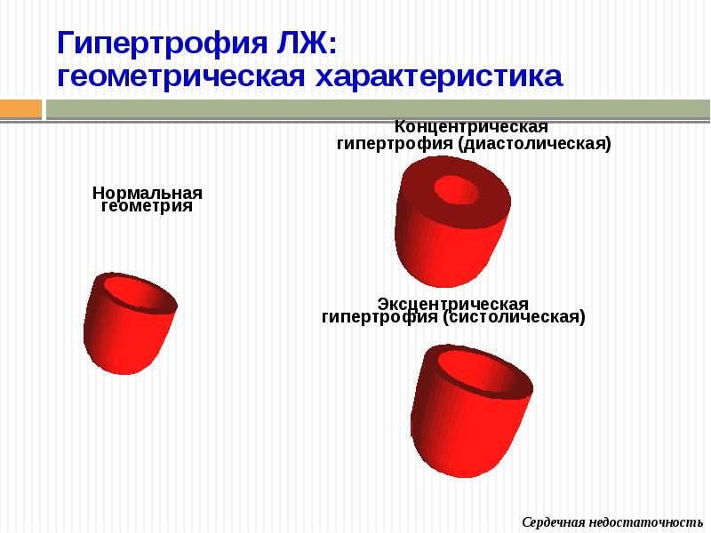 Концентрическое ремоделирование стенок лж