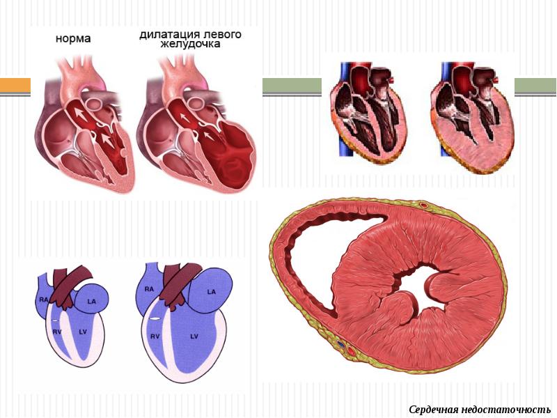 Сердечная недостаточность картинки