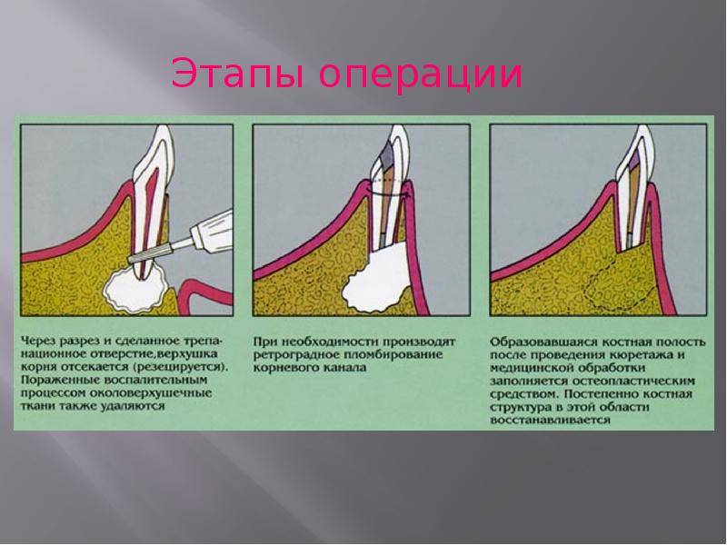 Перелом корня зуба презентация