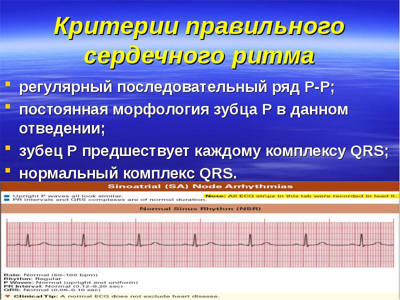 Аритмии у детей презентация