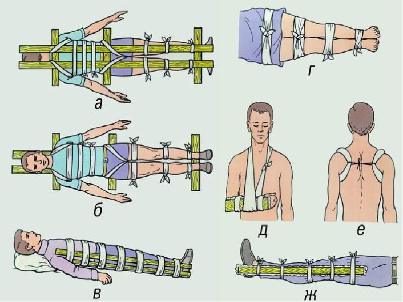 Иммобилизация конечности при открытом переломе