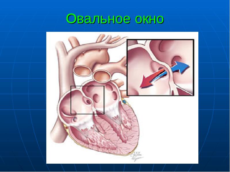 Овальное окно в сердце фото Особенности сердечнососудистой системы у детей