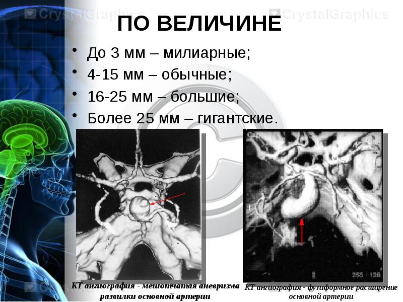 Аневризма сосудов головного мозга презентация