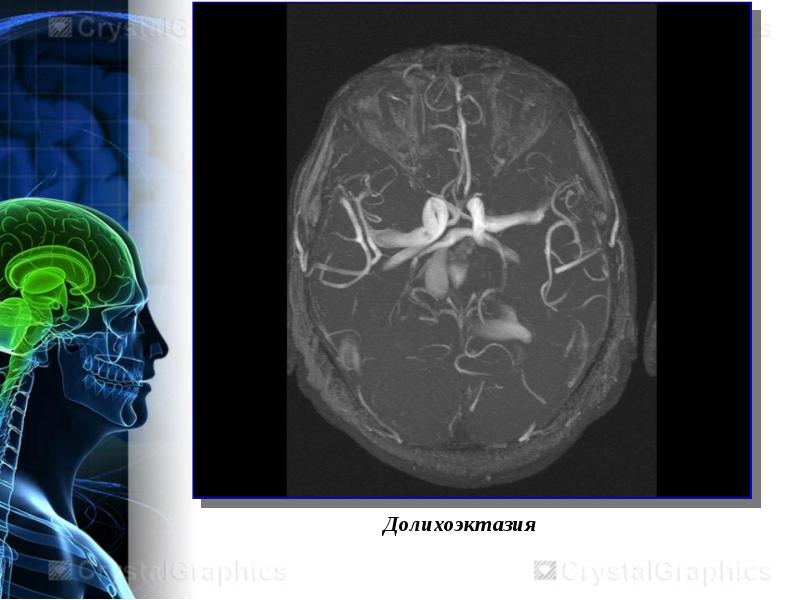Аневризмы сосудов головного мозга презентация