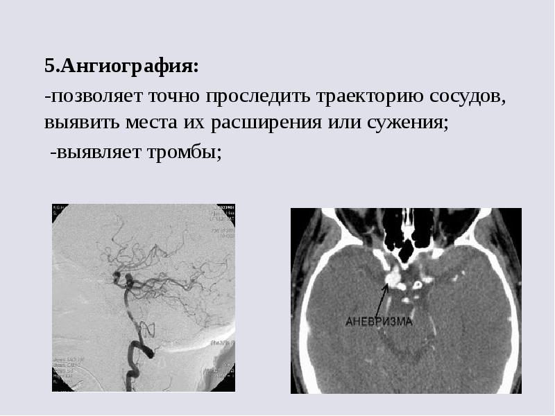 Аневризма мозга отзывы. Аневризматическое расширение артерий. Классификация аневризм головного мозга. Ангиография. Классификация аневризм сосудов.
