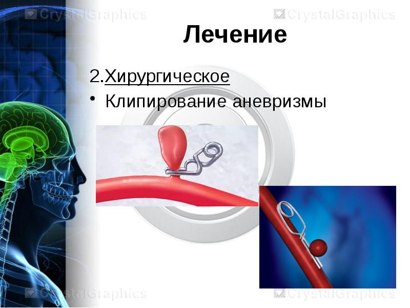 Аневризмы сосудов головного мозга презентация