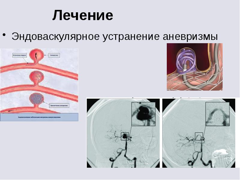 Аневризма сосудов головного мозга презентация