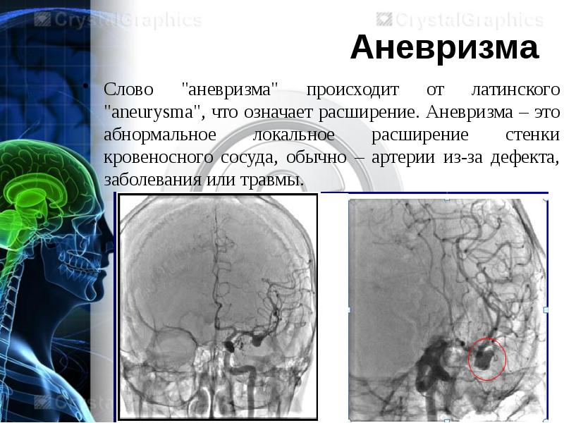 Что такое аневризма головного мозга фото