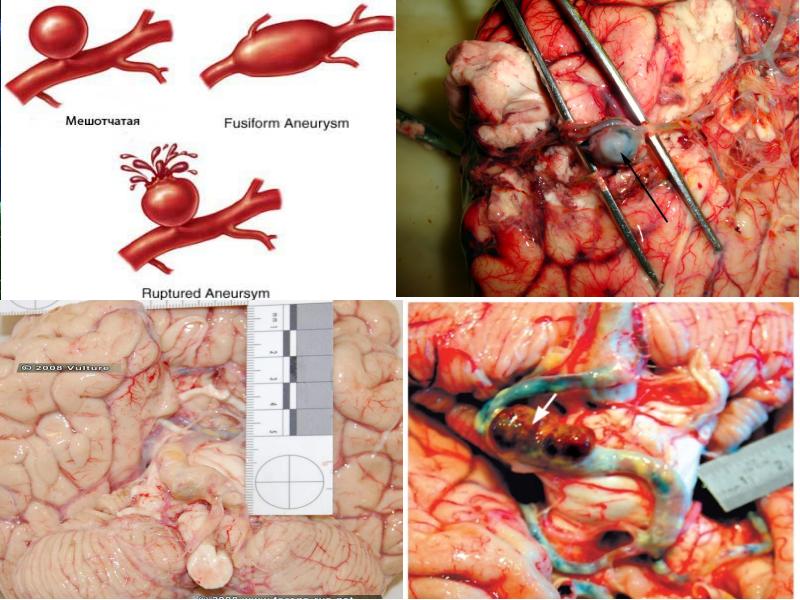 Аневризмы сосудов головного мозга презентация