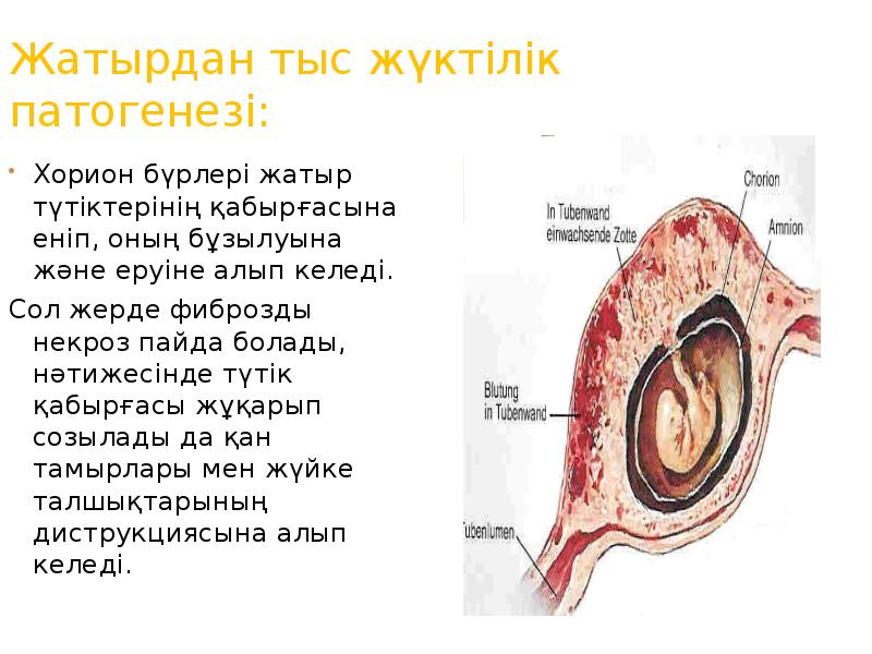 Жатырдан тыс жүктілік презентация