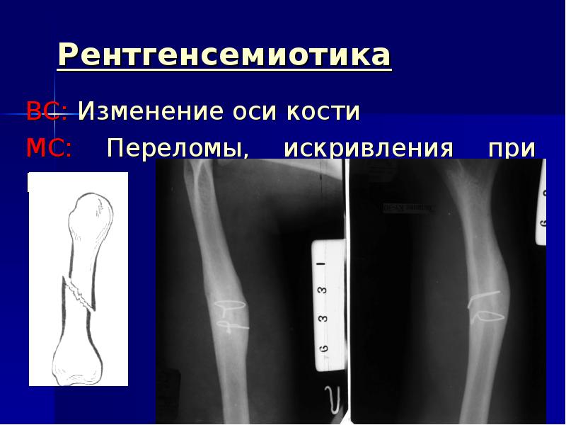 Изм оси. Ось кости. Патология лучевая кость. Искривление оси кости рентген. Длинная ось кости.