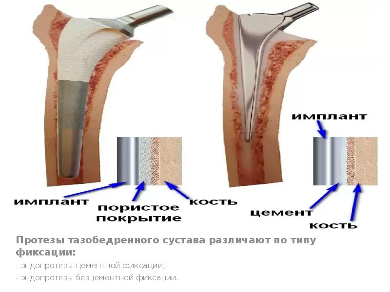 Эндопротезирование коленного сустава презентация